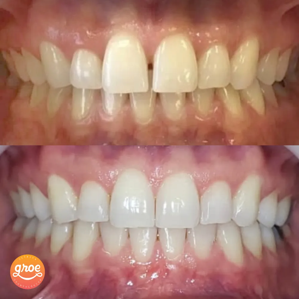 Antes e depois de tratamento com alinhadores