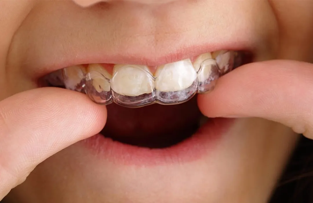 Alinhador transparente sendo colocado nos dentes