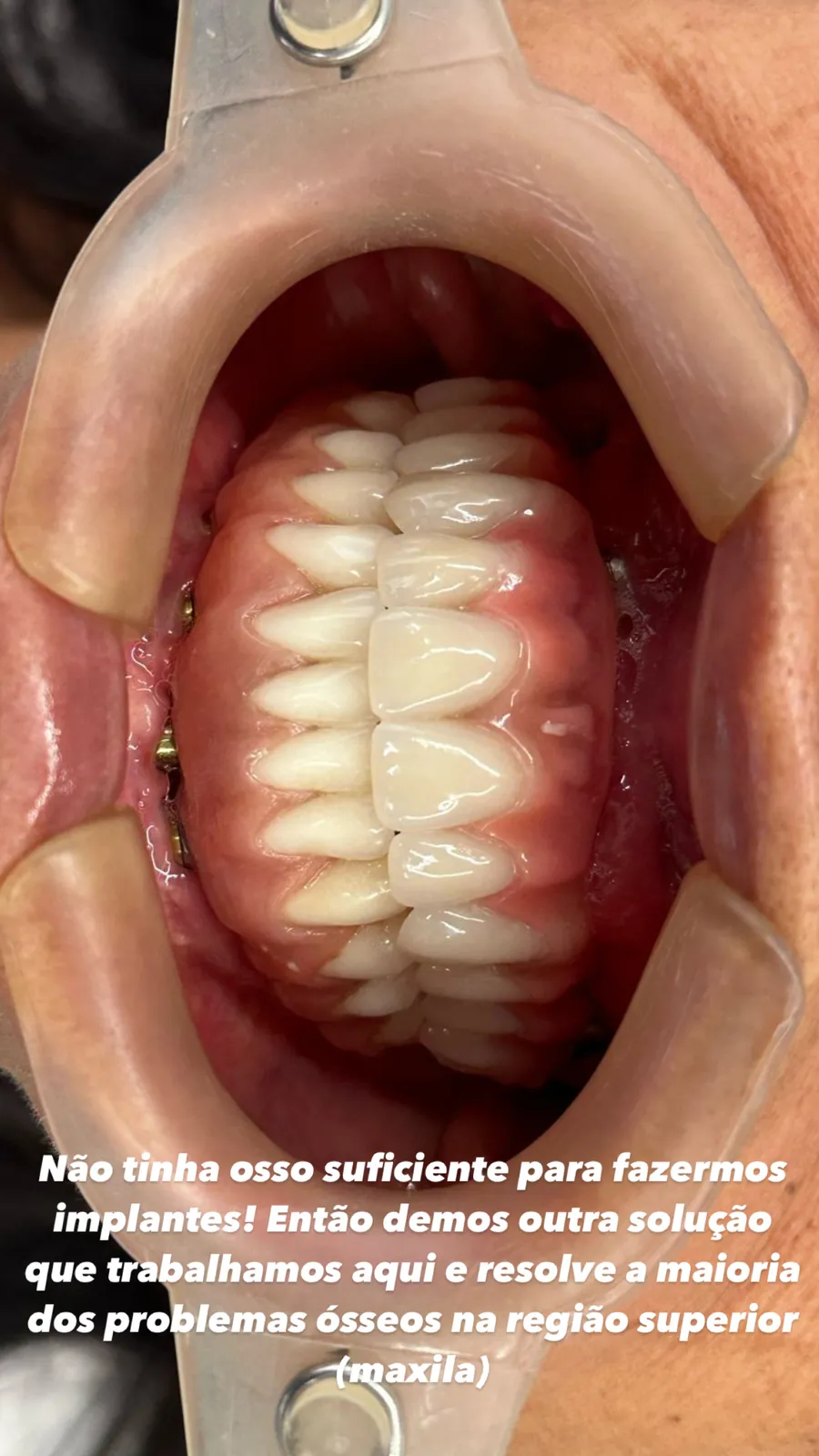 Prótese fixa sobre implantes zigomáticos