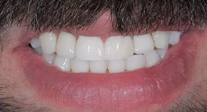Sorriso reabilitado com implantes, caso 1