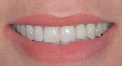 Sorriso reabilitado com implantes, caso 4