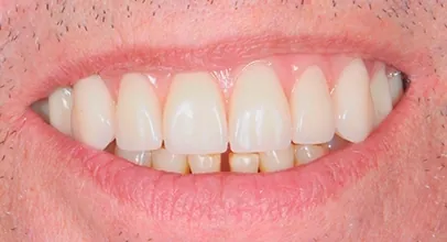 Sorriso reabilitado com implantes, caso 5