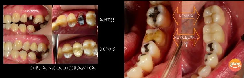 Antes e depois de coroas metalocerâmicas